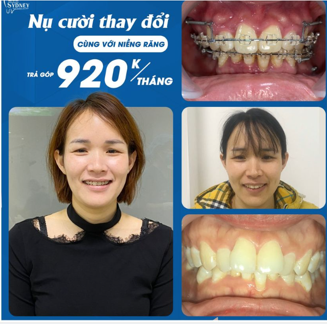 Niềng răng xinh lung linh cùng Nha khoa Hà Nội Sydney