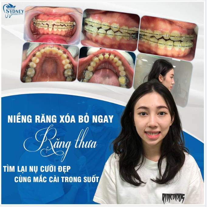 NIỀNG RĂNG XÓA BỎ NGAY RĂNG THƯA