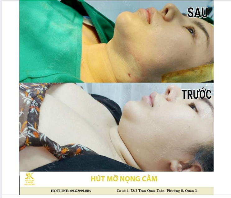 NỌNG CẰM BIẾN MẤT CHỈ SAU 45 PHÚT.