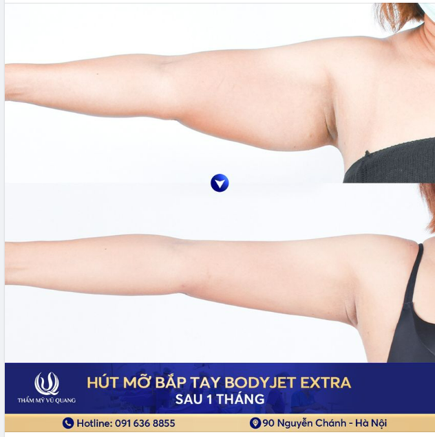 Nữ giám đốc ngân hàng Sở hữu ngay đôi tay thon gọn sau khi Hút mỡ Body Jet Extra.