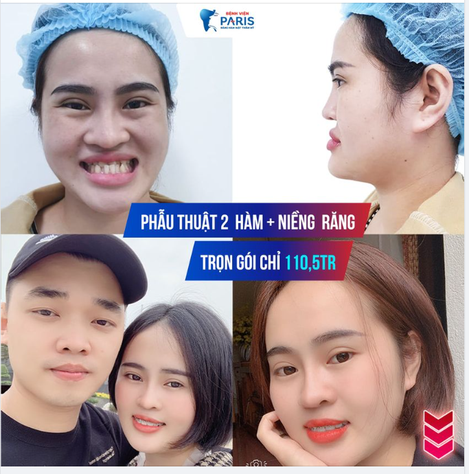 Phẫu thuật Hàm mặt TIÊU CHUẨN PHÁP - GIÁ VIỆT NAM