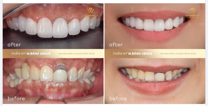 PHỤC HÌNH CA BỌC SỨ HỎNG - TÁI TẠO NỤ CƯỜI MỚI