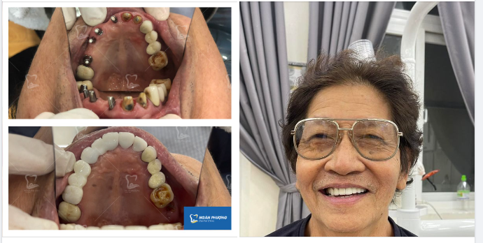 Phục hình Implant- Giải pháp vàng cho hàm răng nhiều "lỗ hổng"
