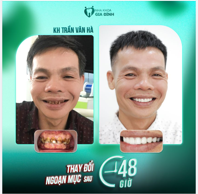 PHỤC HÌNH RĂNG NHIỄM MÀU NẶNG, LẤY LẠI VẺ PHONG ĐỘ THỜI HOÀNG KIM