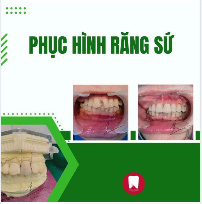 PHỤC HÌNH RĂNG SAU ĐIỀU TRỊ TUỶ NHANH GỌN - AN TOÀN