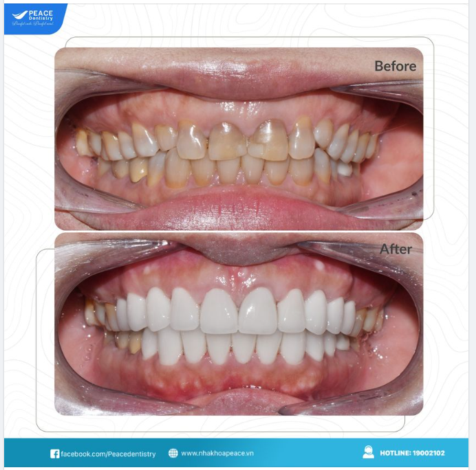 PHƯƠNG PHÁP KHẮC PHỤC RĂNG NHIỄM TETRACYLINE