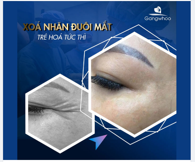 PHƯƠNG PHÁP THẨM MỸ XÓA NHĂN ĐUÔI MẮT LÀ GÌ