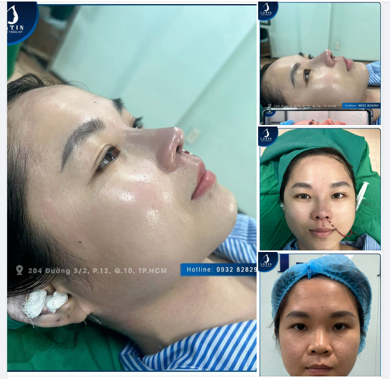 Quên đi mũi xấu - Tự tin cùng dáng mũi đẹp xinh