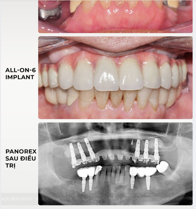 Quý khách hàng ưu đãi đặc biệt dành cho dịch vụ cấy ghép Implant trong tháng 9: