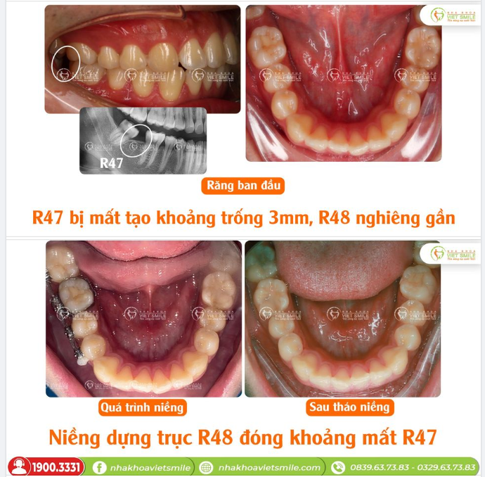 RĂNG 8 (RĂNG KHÔN) CÓ THỰC SỰ MỌC "NGU"?