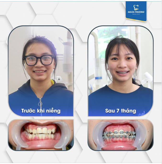 RĂNG ĐÃ BỌC SỨ CÓ NIỀNG RĂNG ĐƯỢC KHÔNG