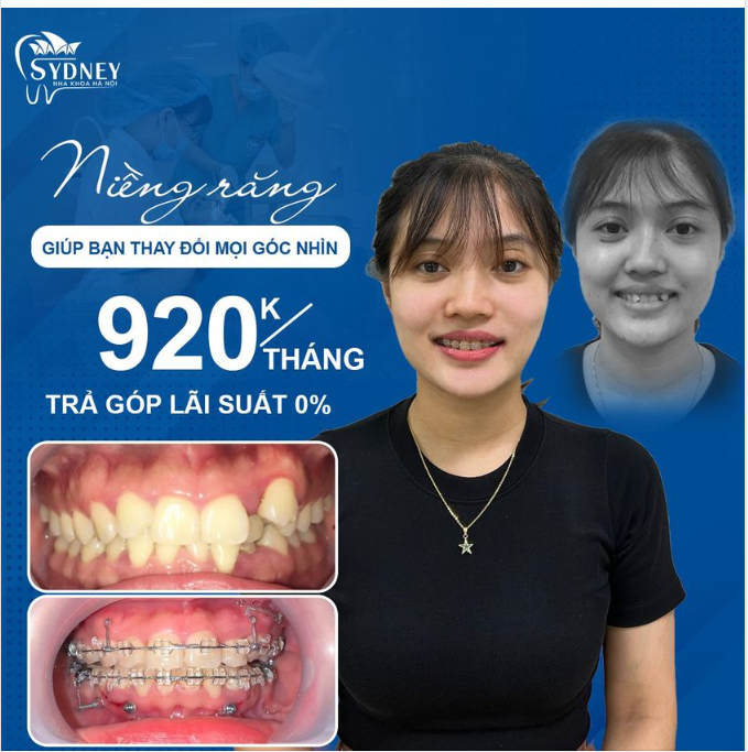 RĂNG ĐẸP MỘT CHÚT THÌ VUI