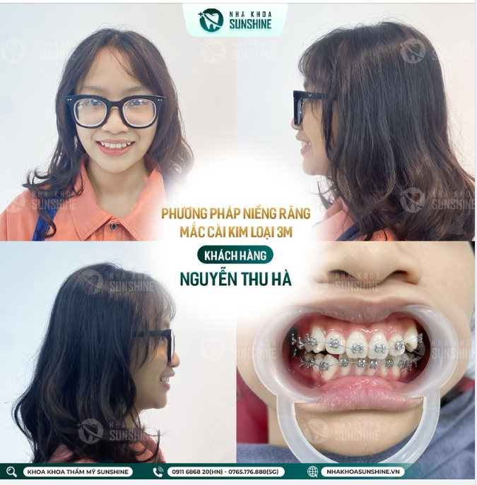 RĂNG KHẤP KHỂNH TẠI SAO KHÔNG CHỌN NIỀNG RĂNG