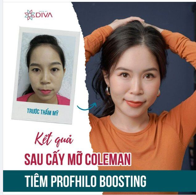 RẠNG NGỜI, TRẺ TRUNG SAU CẤY MỠ COLEMAN + TIÊM PROFHILO