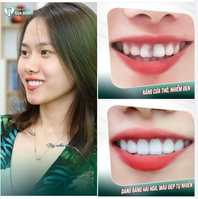 RĂNG XỈN MÀU THÌ PHẢI DÁN SỨ VENEER NGAY THÔI