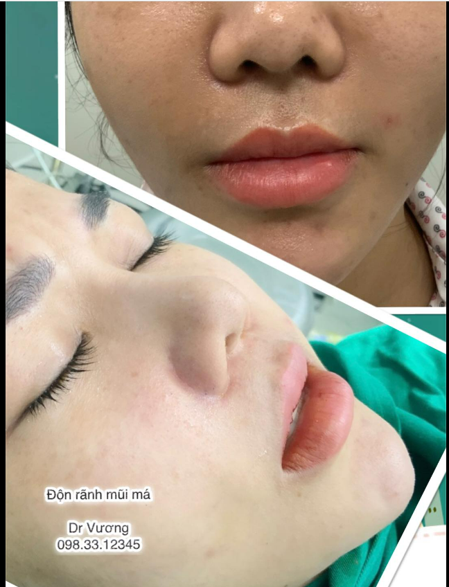 Rãnh mũi má sâu thì độn vẫn là phương án khả quan nhất so với các phương án như filler, cấy mỡ, ...