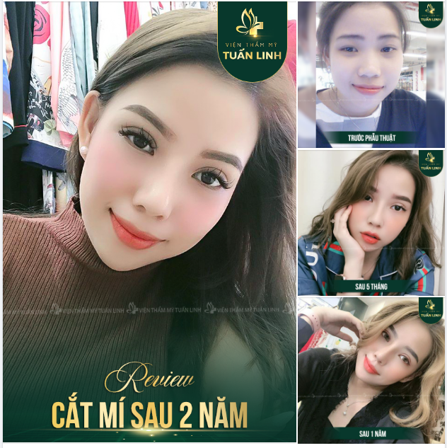 Review cắt mí của cô nàng 9X xinh đẹp