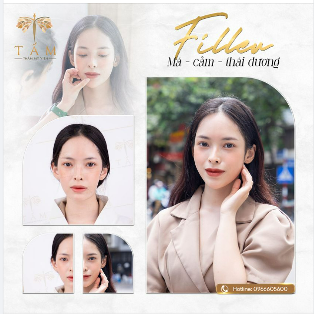 Sắc đẹp thăng hoa nhờ Combo Filler Má - Cằm - Thái dương
