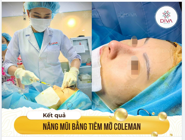 SAU CẤY MỠ COLEMAN MŨI DÁNG MŨI THAY ĐỔI NHƯ THẾ NÀO