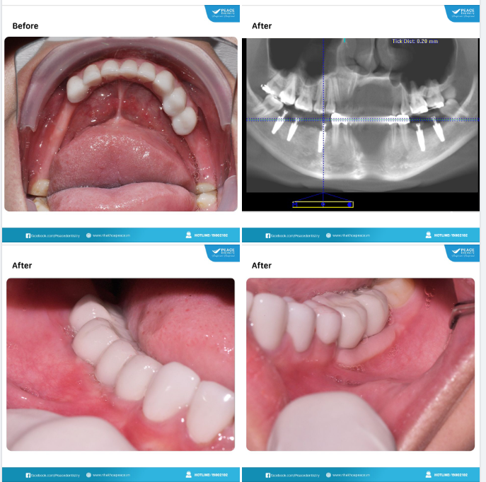 SAU KHI CẤY TRỤ IMPLANT BAO LÂU THÌ MỚI CÓ THỂ CỐ ĐỊNH RĂNG SỨ LÊN IMPLANT