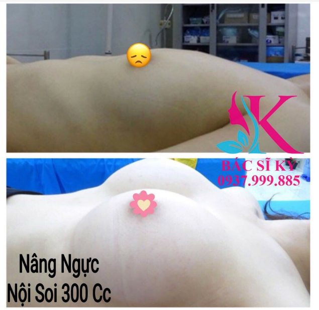 Những lưu ý sau phẫu thuật Nâng Ngực Nội Soi Chân Không tại Bs Kỳ Y Dược