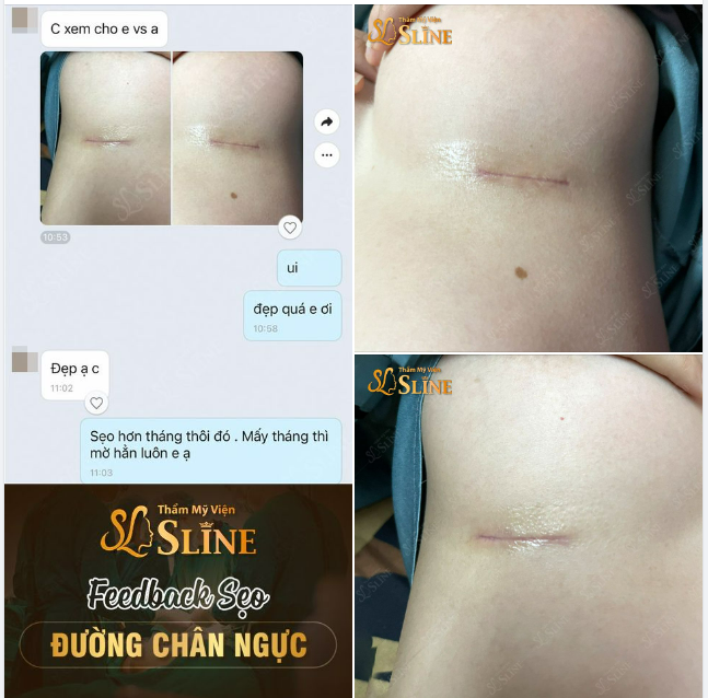 SẸO ĐẶT TÚI ĐƯỜNG CHÂN NGỰC sau 1 tháng.