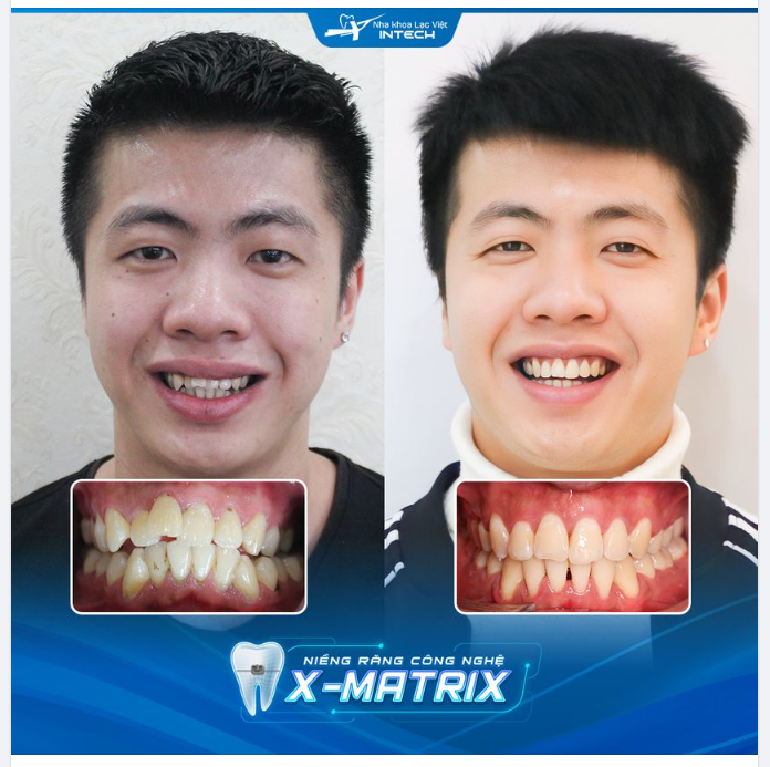 SỞ HỮU DIỆN MẠO ĐIỂN TRAI SAU KHI NIỀNG RĂNG CÔNG NGHỆ X-MATRIX