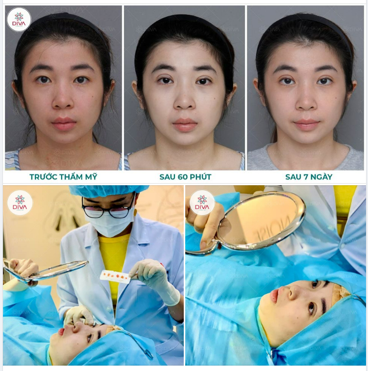 SỞ HỮU MẮT 2 MÍ TỰ NHIÊN SAU NHẤN MÍ