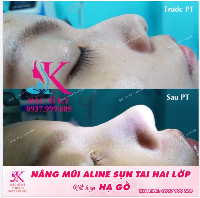 Sống mũi gồ nói nên điều gì