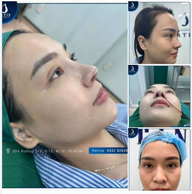 SỬA LẠI MŨI CẤU TRÚC BỊ BAO XƠ LẦN 3 SẼ NHƯ THẾ NÀO