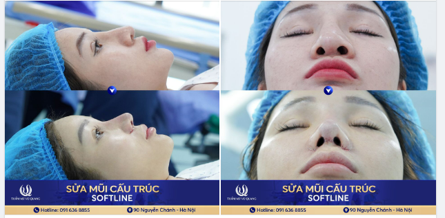 Sửa lại mũi hỏng - Có dễ dàng như bạn nghĩ