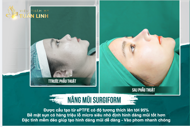 SỤN SURGIOFRM LUÔN LÀ LỰA CHỌN HÀNG ĐẦU TRONG THẨM MỸ NÂNG MŨI.