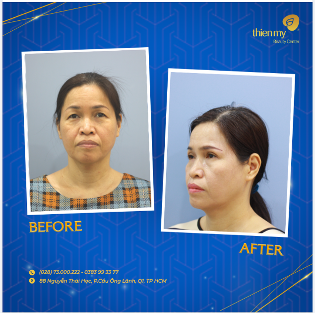 Sụp mí mắt ở độ tuổi trung niên!
