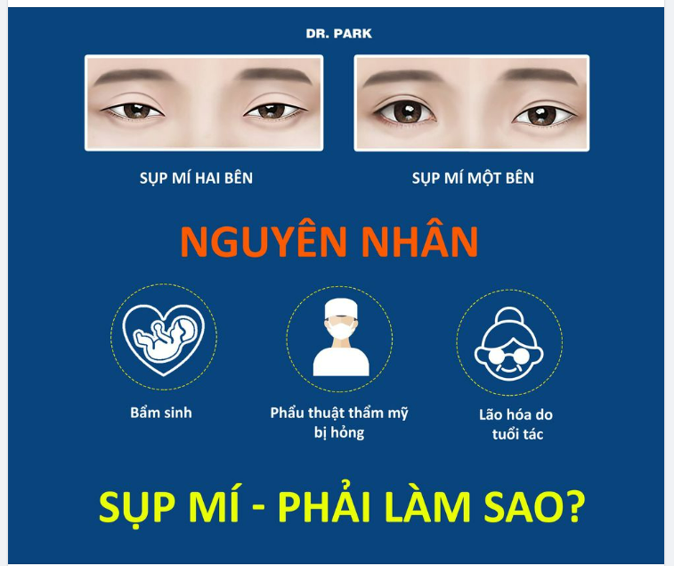 SỤP MÍ - XÁC ĐỊNH NGUYÊN NHÂN ĐỂ SỬA CHO ĐÚNG!