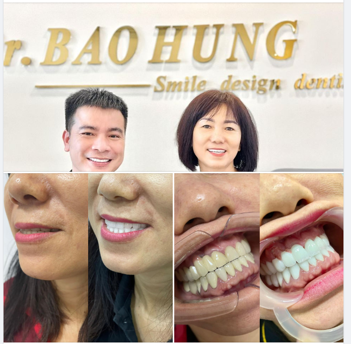 Tái khám định kì cho c sau 6th làm răng sứ. Mọi thứ rất tuyệt vời c nói vậy