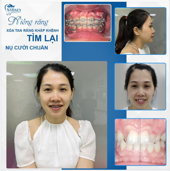 Tại sao nên niềng răng khấp khểnh?