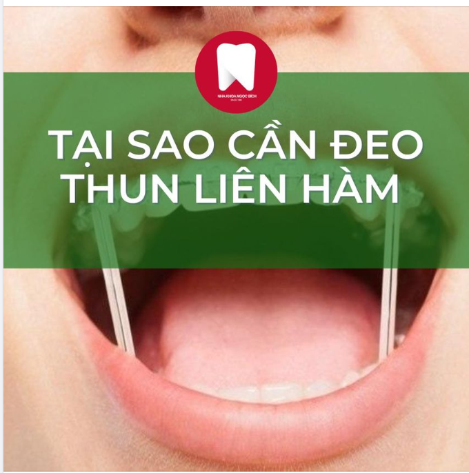 TẠI SAO PHẢI ĐEO THUN LIÊN HÀM KHI NIỀNG RĂNG