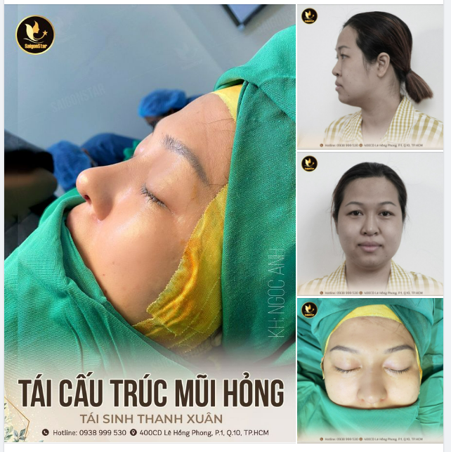 TÁI SINH MŨI HỎNG - TÁI SINH THANH XUÂN