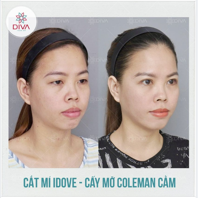 TẠM BIỆT CẰM LẸM, MÍ LÓT, MẮT NHỎ - GƯƠNG MẶT TƯƠI TRẺ, THU HÚT SAU THẨM MỸ