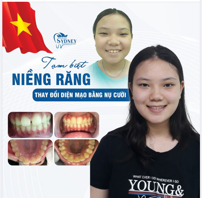 TẠM BIỆT RĂNG THƯA – ĐÓN NỤ CƯỜI XINH