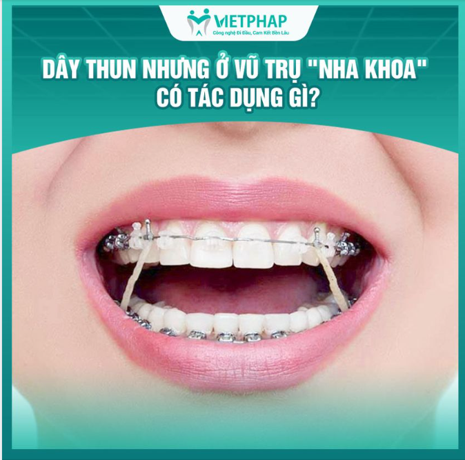 TẦM QUAN TRỌNG CỦA DÂY THUN KHI NIỀNG RĂNG