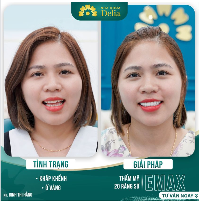 Thẩm mỹ 20 răng sứ cao cấp - Nụ cười hoàn hảo thay đổi sau 48h.