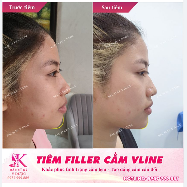 THẨM MỸ NỘI KHOA - LÀM ĐẸP KHÔNG CẦN PHẪU THUẬT TẠO HÌNH BẰNG FILLER