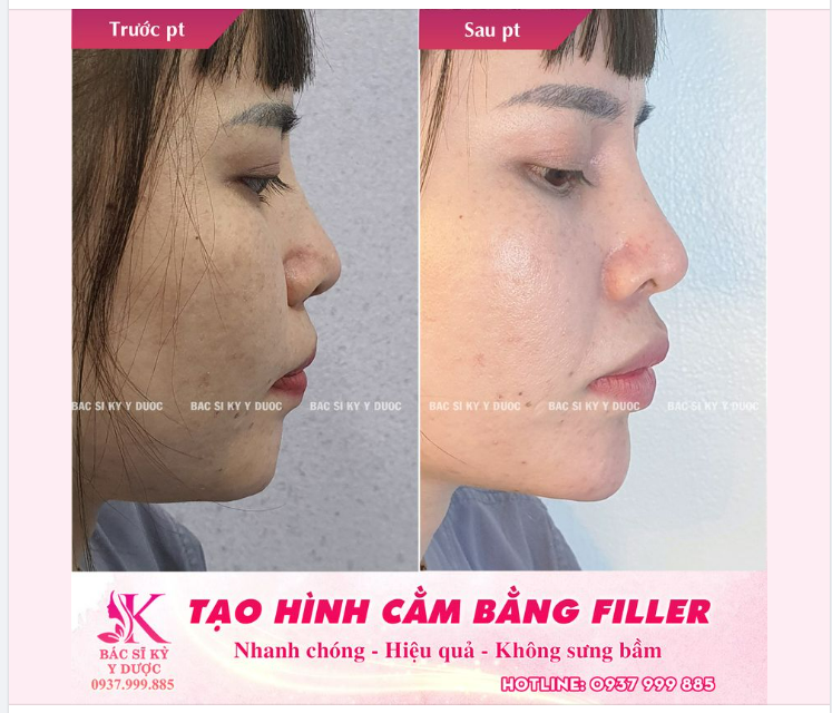 THẨM MỸ NỘI KHOA - LÀM ĐẸP KHÔNG CẦN PHẪU THUẬT TẠO HÌNH BẰNG FILLER