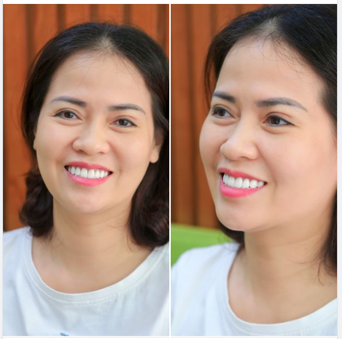 THẨM MỸ RĂNG SỨ - “CỨU CÁNH” CHO NỤ CƯỜI KHIẾM KHUYẾT CỦA BẠN