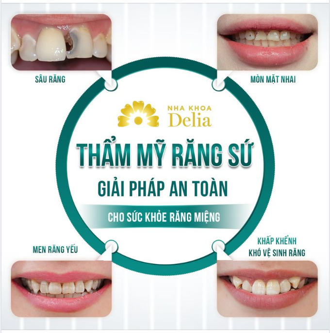 THẨM MỸ RĂNG SỨ - GIẢI PHÁP HÀNG ĐẦU CHO MỘT NỤ CƯỜI RẠNG RỠ