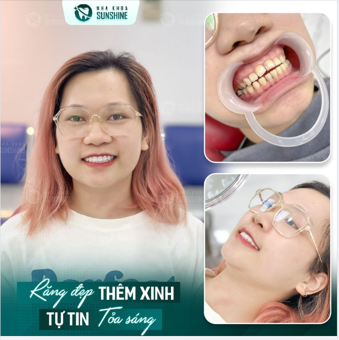 THẨM MỸ RĂNG SỨ LÀM ĐẸP LÀ KHÔNG CHỜ ĐỢI
