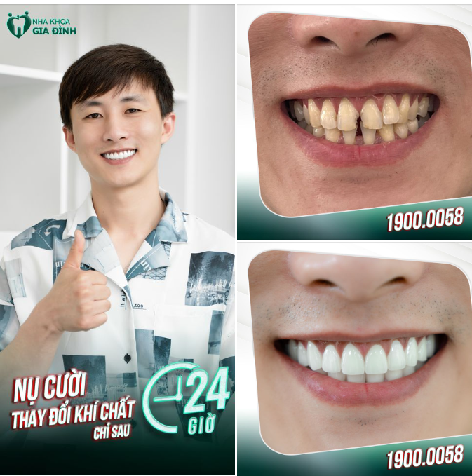 THẨM MỸ RĂNG SỨ - LẤY LẠI BẢN LĨNH PHÁI MẠNH