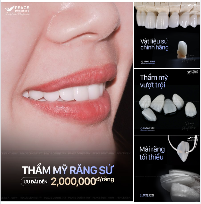 THẨM MỸ RĂNG SỨ VỚI ƯU ĐÃI ĐẶC BIỆT HẤP DẪN TẠI NHA KHOA PEACE DENTISTRY