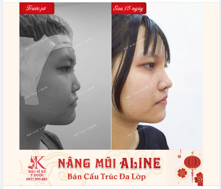 THĂNG HẠNG NHAN SẮC CHỈ SAU 15 NGÀY NÂNG MŨI